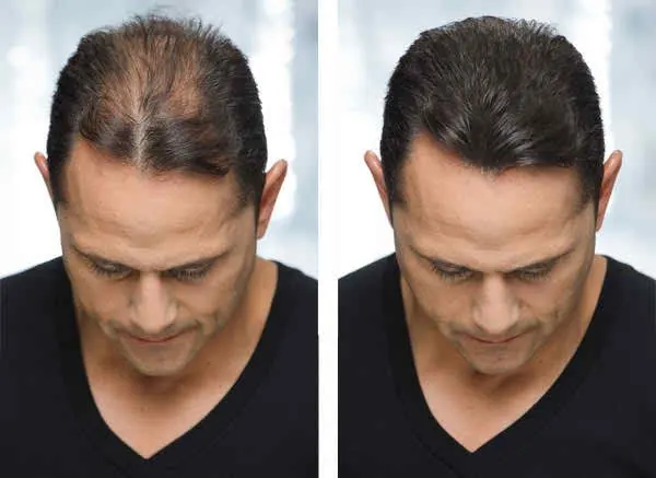 Meso Treatments — advanced skin treatment at a beauty salon in Indore